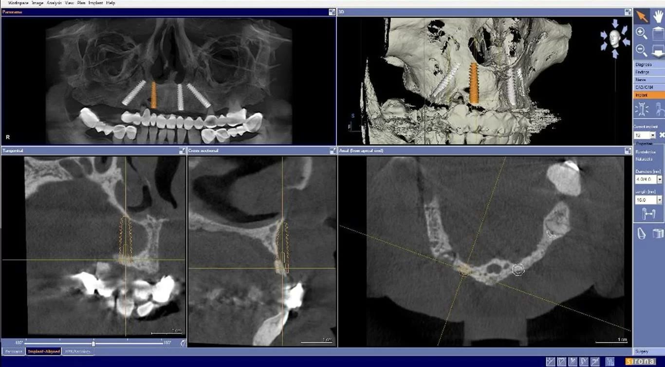 Planificarea digitală pe tomografie: traseul implantului zigomatic marcat cu portocaliu, alături de reconstrucția tridimensională