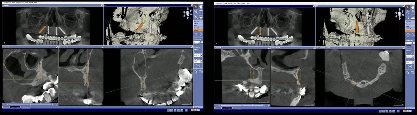Două capturi din planificarea virtuală a implanturilor la maxilar, pe secțiunile tomografiei dentare