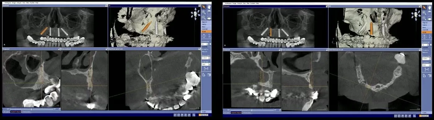 Două capturi din planificarea virtuală a implanturilor la maxilar, pe secțiunile tomografiei dentare