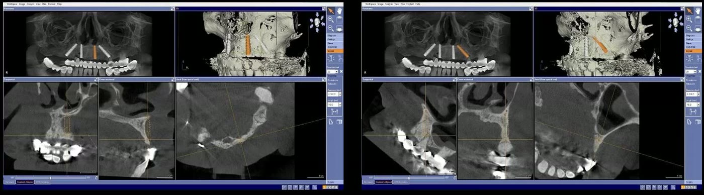 Alte două capturi din planificarea virtuală a implanturilor, cu secțiunile prin osul maxilar și reconstrucțiile 3D