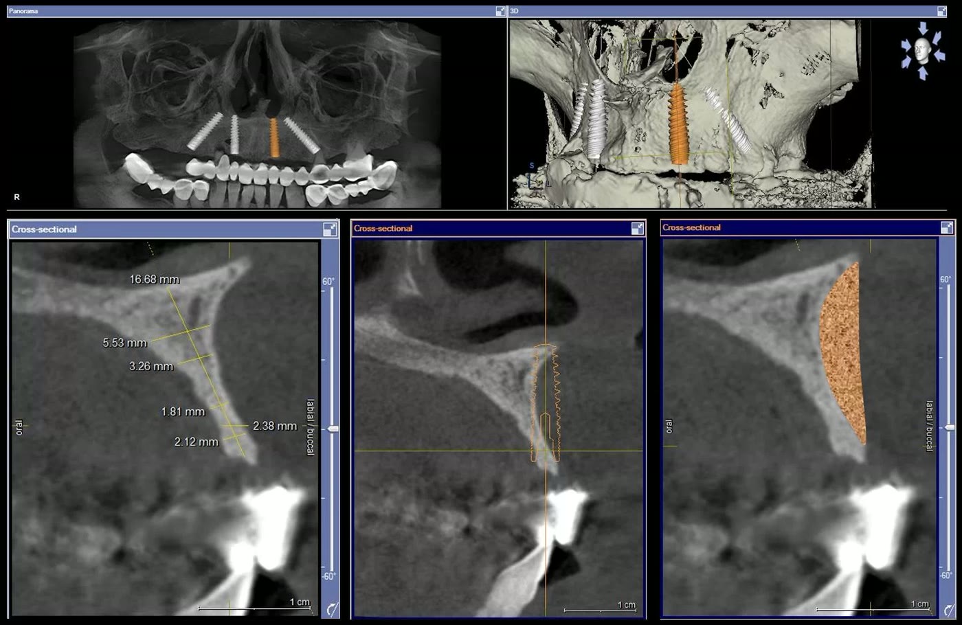 Măsurători pe secțiunile tomografiei dentare: grosimea osului maxilar rămas, exprimată în milimetri, alături de simularea unei adiții osoase