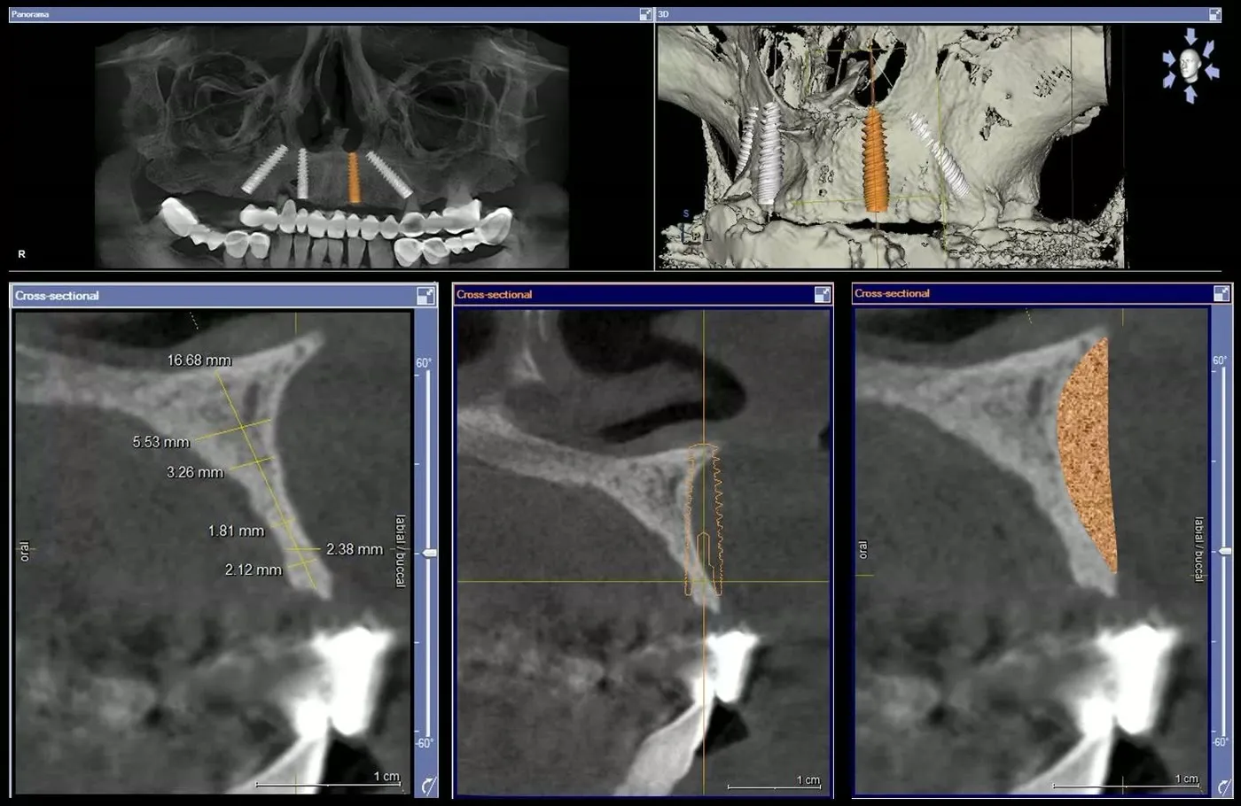 Măsurători pe secțiunile tomografiei dentare: grosimea osului maxilar rămas, exprimată în milimetri, alături de simularea unei adiții osoase