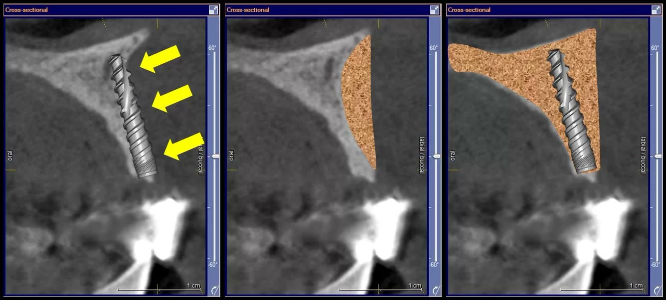Simulare virtuală pe secțiuni de tomografie: un implant convențional nu găsește suficient os în care să se ancoreze