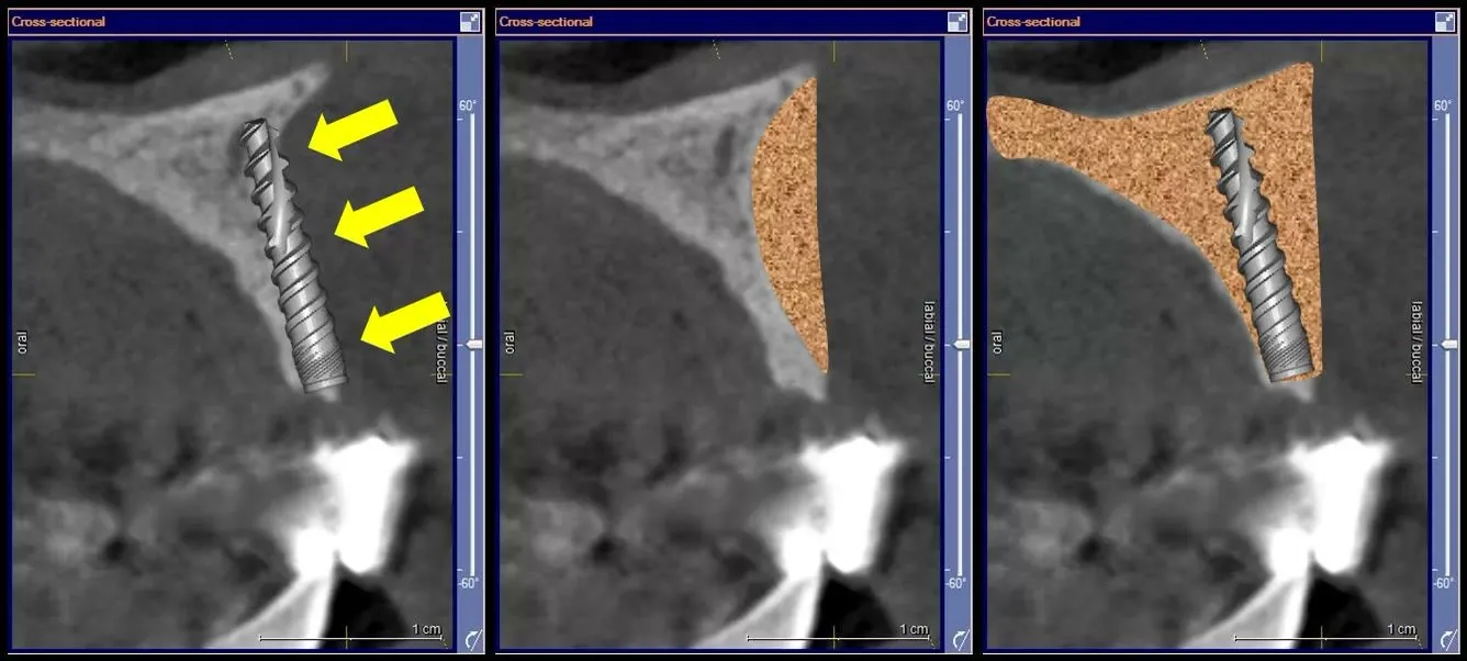 Simulare virtuală pe secțiuni de tomografie: un implant convențional nu găsește suficient os în care să se ancoreze