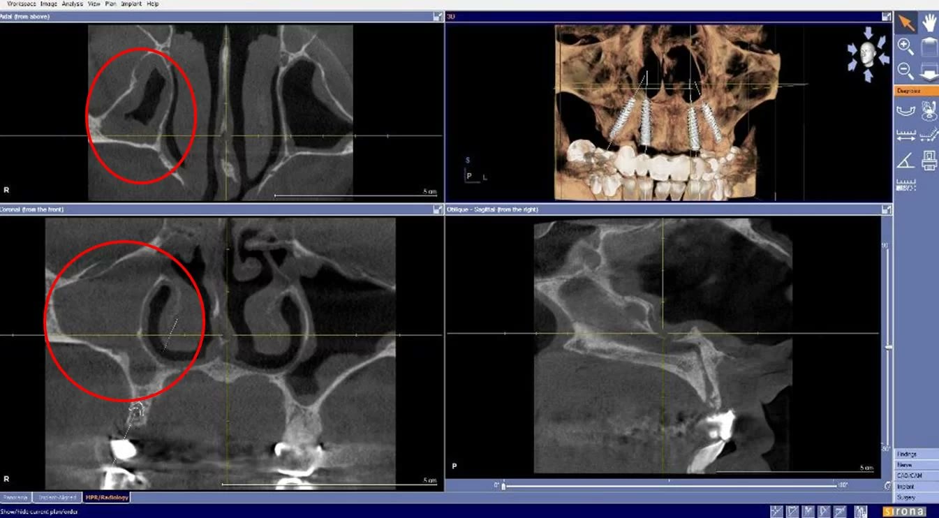 Secțiuni din tomografia dentară cu sinusul maxilar drept marcat, afectat de sinuzită cronică
