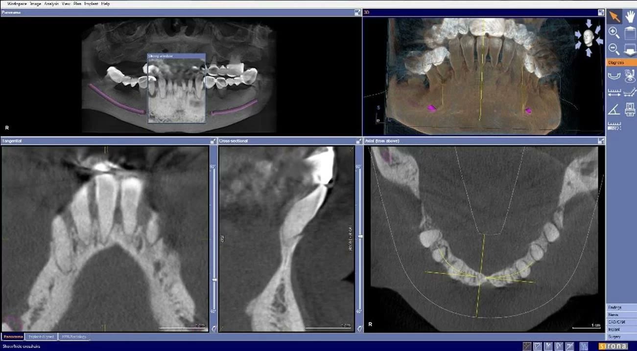 Secțiuni din tomografia dentară care arată resorbția severă a osului la nivelul rădăcinilor dinților naturali