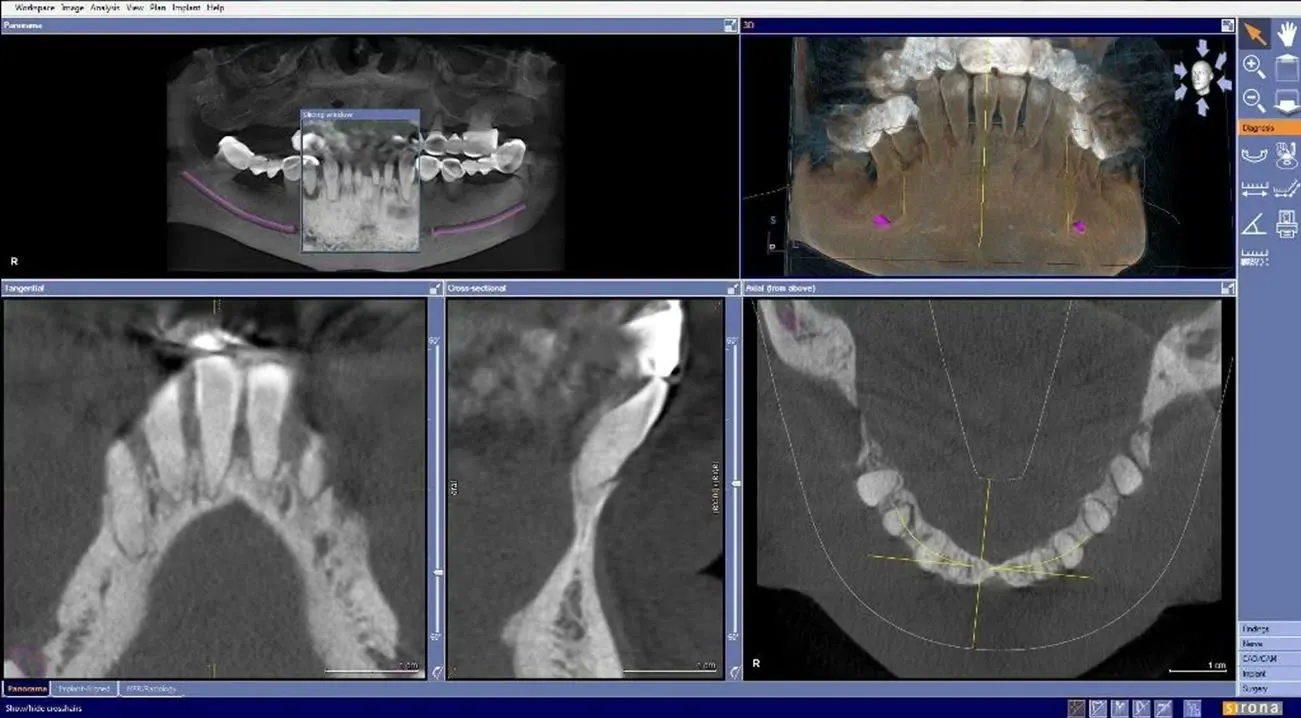 Secțiuni din tomografia dentară care arată resorbția severă a osului la nivelul rădăcinilor dinților naturali