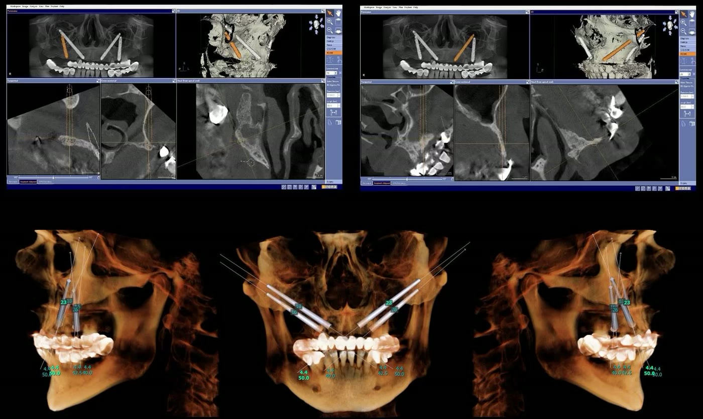 Planificarea implanturilor zigomatice: capturi din software-ul de tomografie și reconstrucții tridimensionale ale craniului cu traseul implanturilor