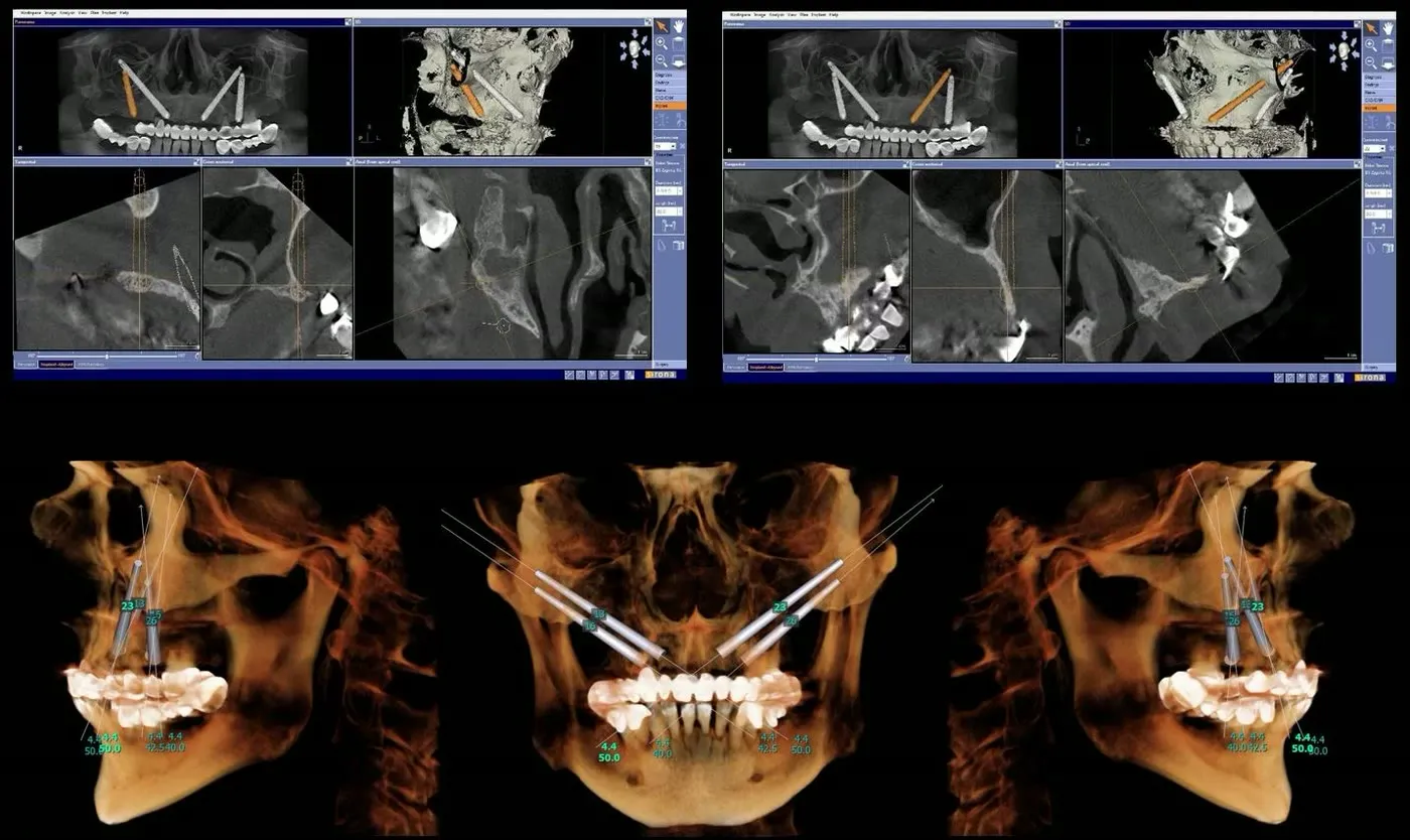 Planificarea implanturilor zigomatice: capturi din software-ul de tomografie și reconstrucții tridimensionale ale craniului cu traseul implanturilor