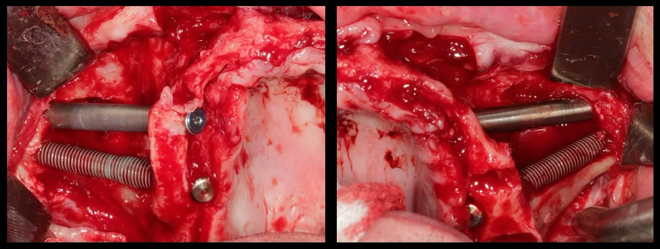 Imagini intraoperatorii de detaliu: corpul implanturilor zigomatice, inserate pe traseul pregătit prin fereastra sinuzală