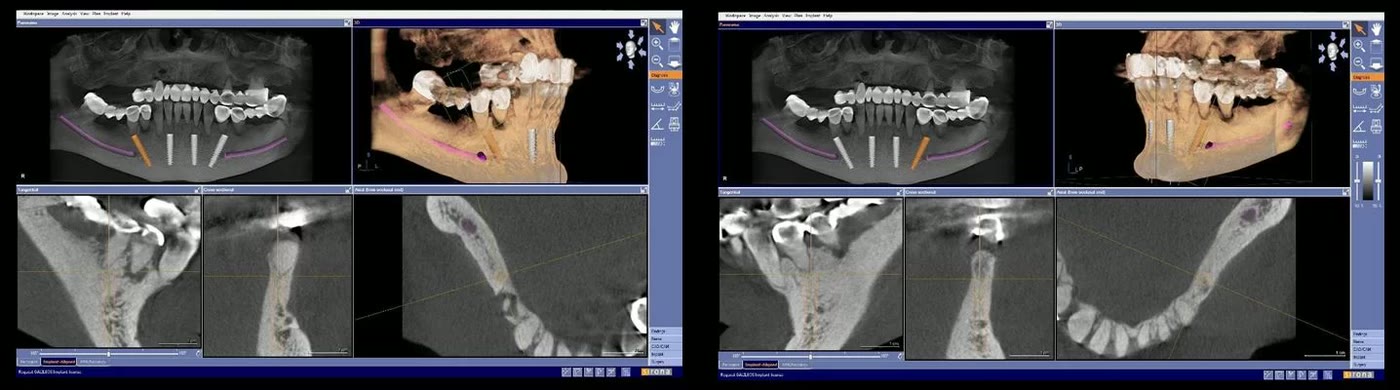 Două capturi din planificarea implanturilor mandibulare, cu nervul alveolar inferior trasat pe imagine