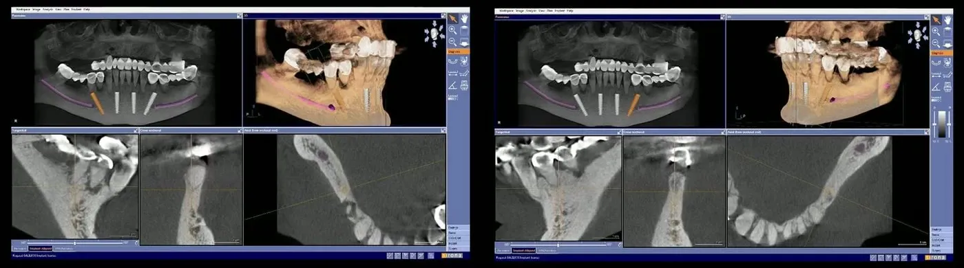 Două capturi din planificarea implanturilor mandibulare, cu nervul alveolar inferior trasat pe imagine