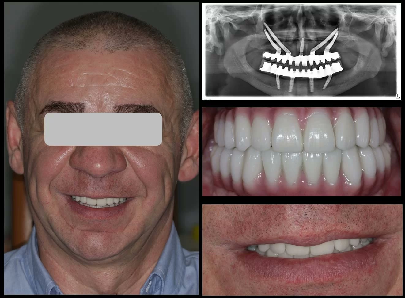 Pacient reabilitat cu implanturi zigomatice la maxilar și implanturi înclinate la mandibulă: fotografia zâmbetului, radiografia panoramică finală și lucrarea fixă