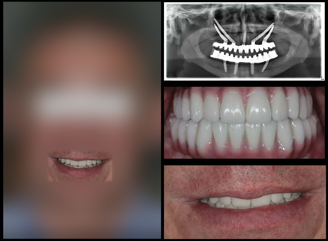 Rezultatul final: radiografia panoramică de control, lucrările fixe văzute din față și zâmbetul refăcut