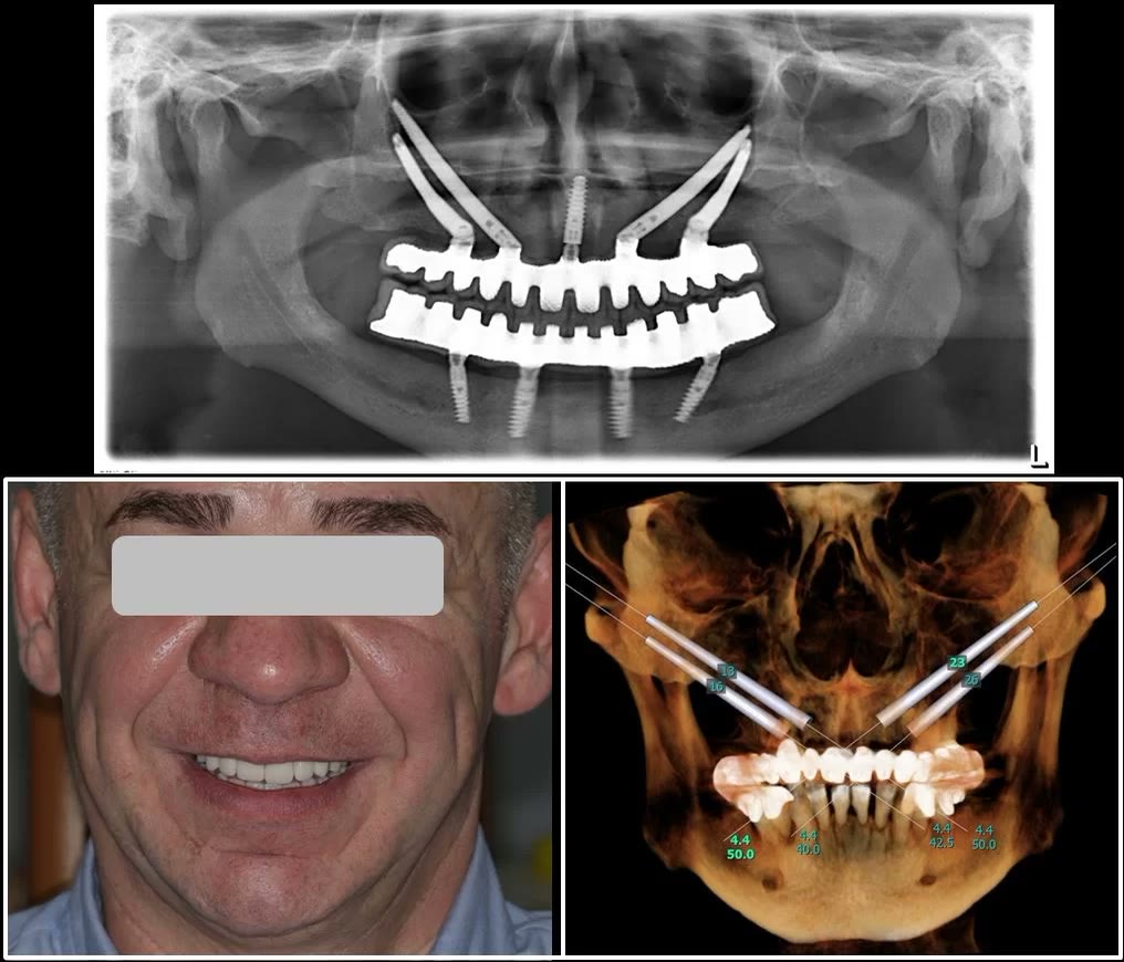 Radiografia panoramică finală, cu lucrările fixe înșurubate la implanturi, alături de reconstrucția 3D a planificării implanturilor zigomatice