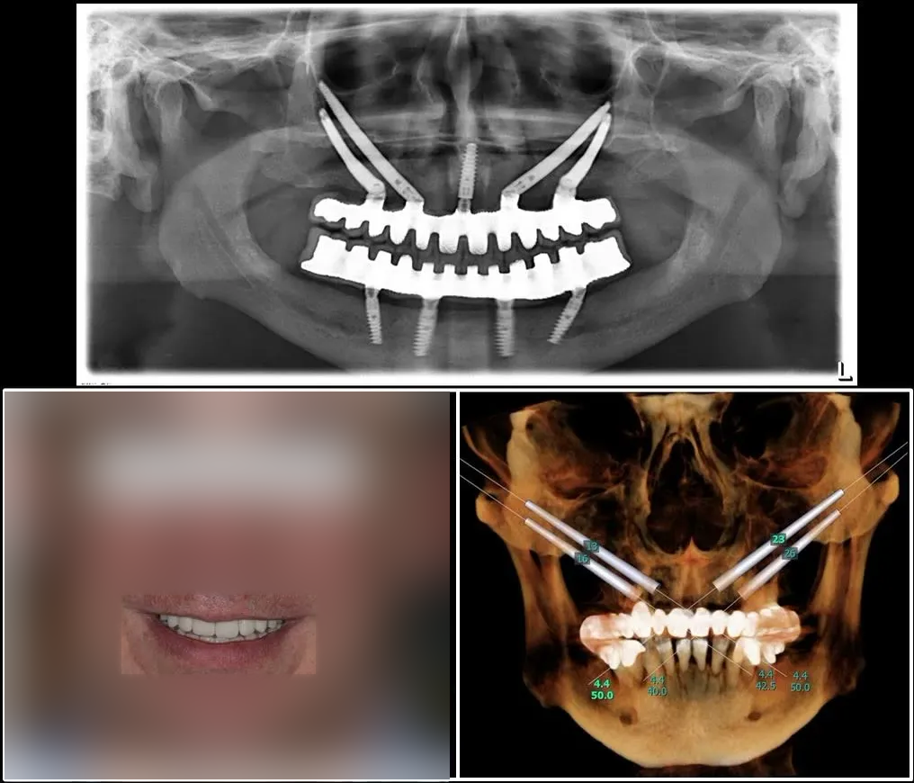 Radiografia panoramică finală, cu lucrările fixe înșurubate la implanturi, alături de reconstrucția 3D a planificării implanturilor zigomatice
