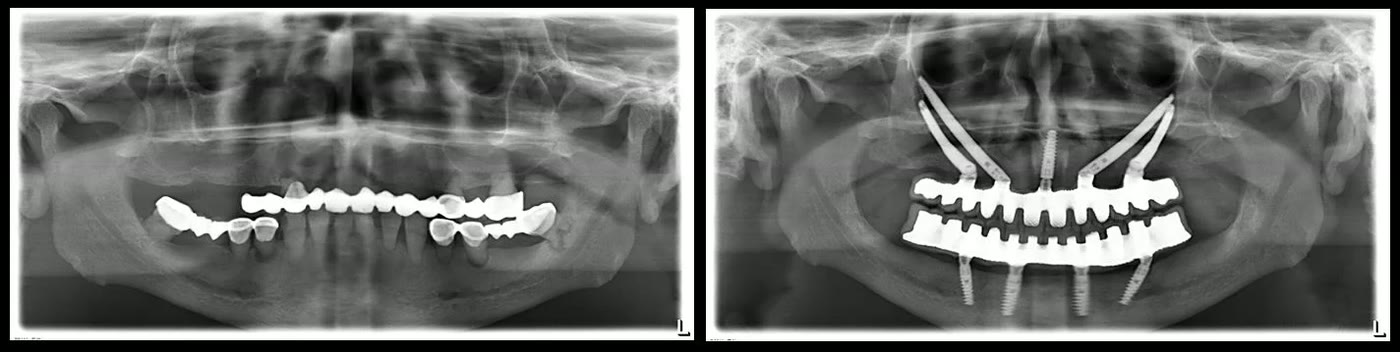Două radiografii panoramice alăturate: situația preoperator, cu punți pe dinți compromiși, și rezultatul la finalizarea tratamentului, cu implanturi și lucrări fixe