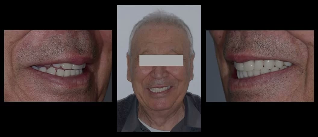 Zâmbetul pacientului după reabilitare, în fotografii de detaliu și de față
