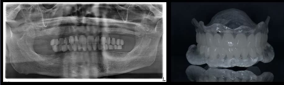 Radiografia panoramică realizată cu șablonul radiologic în gură, alături de șablonul transparent confecționat prin duplicarea protezelor