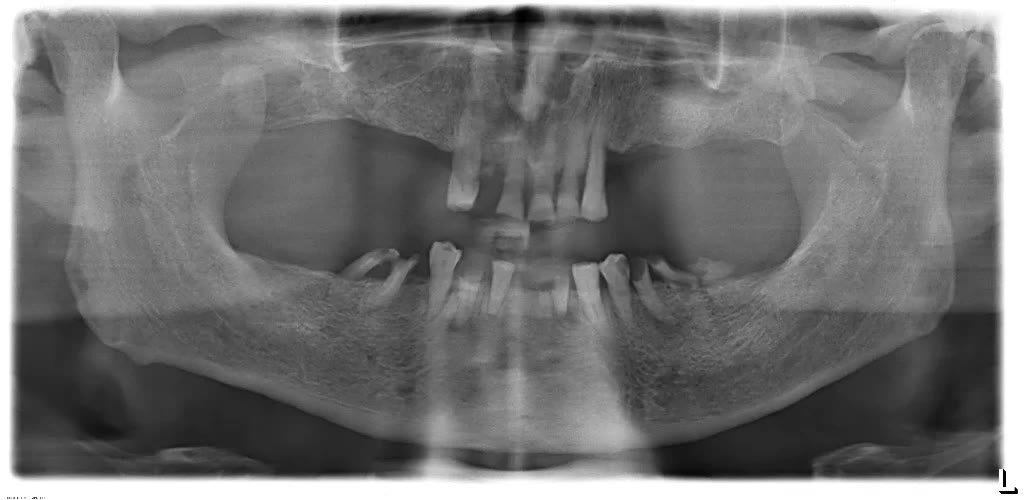 Radiografia panoramică preoperator: doar câțiva dinți restanți, sever degradați, pe creste osoase resorbite