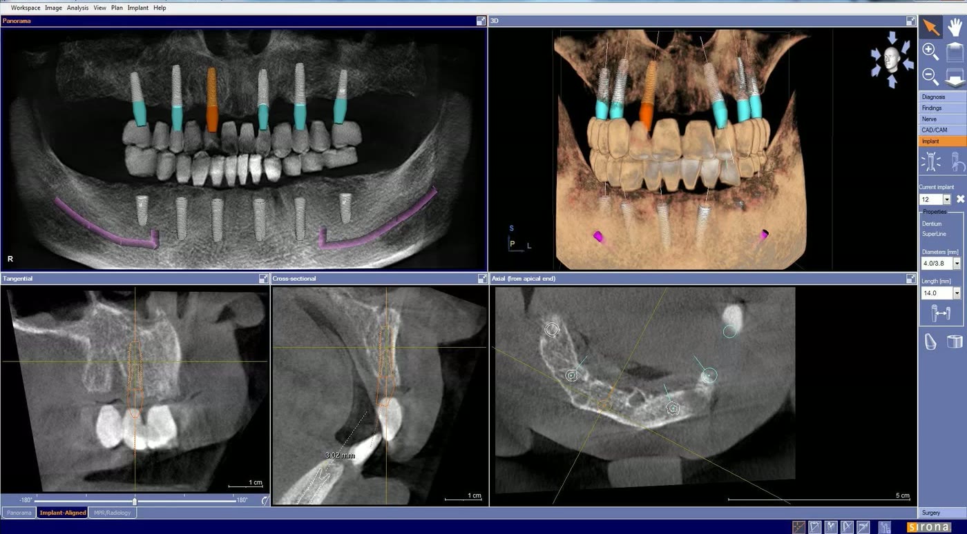 Planificarea virtuală a celor 12 implanturi pe tomografia dentară, cu traseul nervilor alveolari inferiori marcat