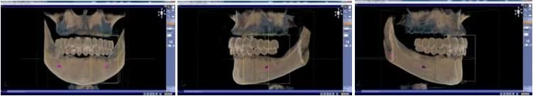 Trei reconstrucții tridimensionale din tomografia dentară, cu dinții șablonului radiologic vizibili peste crestele edentate