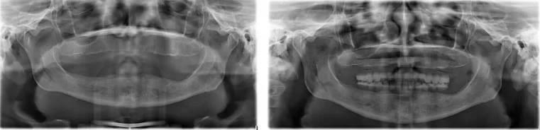 Radiografii panoramice: maxilarele edentate și aceleași maxilare cu șablonul radiologic în gură