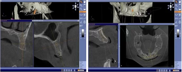 Planificarea digitală a implanturilor pe secțiunile tomografiei dentare, cu vederile tridimensionale ale maxilarelor