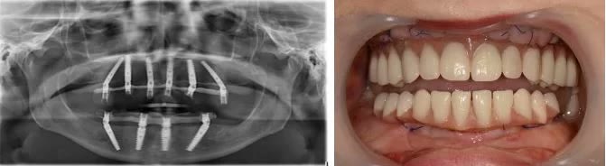 Radiografia panoramică postoperatorie, cu implanturile în poziția planificată, alături de fotografia lucrărilor provizorii fixate în gură