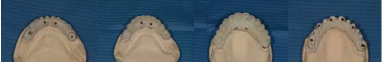 Modelele de lucru folosite împreună cu maestrul tehnician la stabilirea protezării definitive