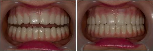 Componenta gingivală a lucrării, pigmentată manual pentru a imita culoarea gingiei naturale