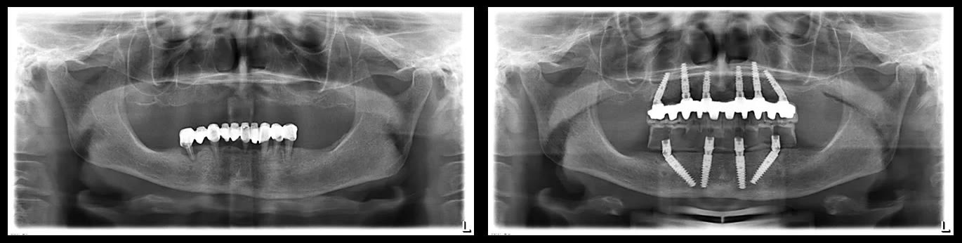 Două radiografii panoramice comparate: înainte de operație, cu maxilarul edentat și puțini dinți restanți jos, și după operație, cu implanturile și lucrările fixe pe ambele arcade