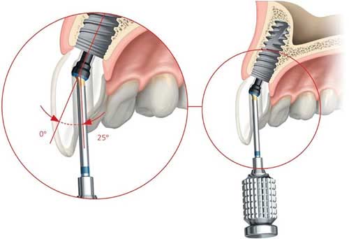 Schemă cu bontul protetic înșurubat pe implant, prezentat la 0 grade și la 25 de grade de angulare