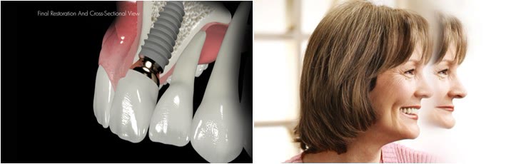 În stânga, secțiune ilustrată printr-un implant dentar cu bont protetic și coroană, în os; în dreapta, două femei care zâmbesc