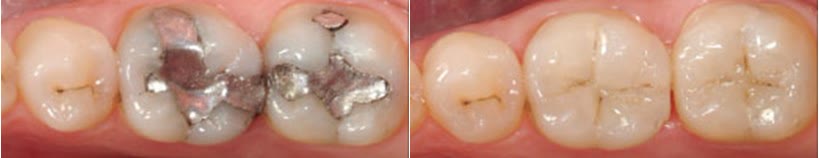 Fotografii comparative de detaliu: în stânga, molari cu obturații vechi din amalgam de argint; în dreapta, aceiași dinți restaurați cu material la culoarea dintelui