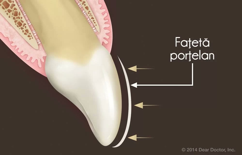 Schemă cu o fațetă din porțelan aplicată pe suprafața unui dinte frontal