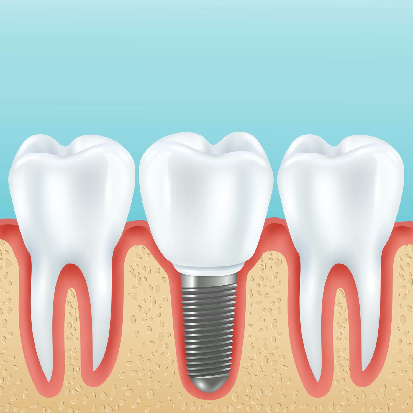 Ilustrație cu o coroană dentară fixată pe un implant, între doi dinți naturali