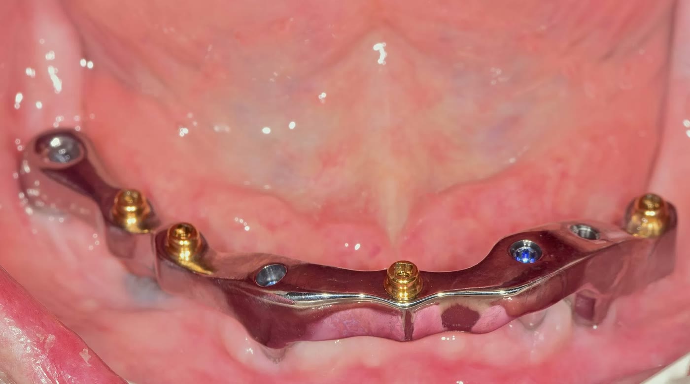 Bara cu locatori înșurubată pe implanturile din mandibulă — imagine intraorală