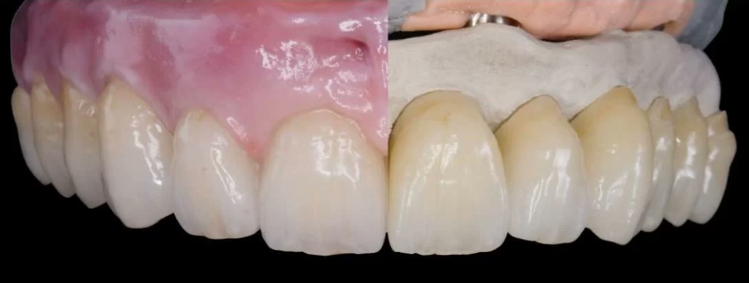 Comparație între o proteză fixă cu gingie artificială roz și aceeași lucrare fără gingie artificială