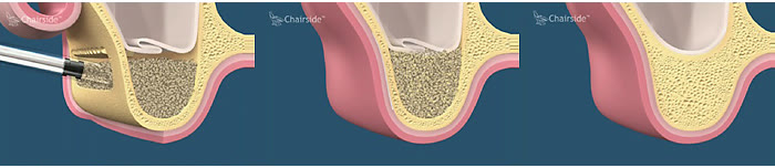Ilustrație a inserării biomaterialului sub mucoasa sinusală și a osului regenerat după vindecare
