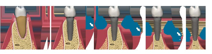 Ilustrație în patru etape: rădăcina naturală, implantul inserat în os și adiția de biomaterial în jurul implantului pentru compensarea resorbției