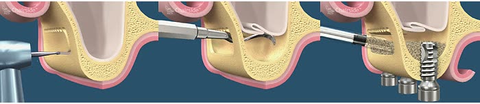 Ilustrație a sinus liftingului: accesul în osul maxilar, inserarea biomaterialului sub mucoasa sinusală și implantul plasat în zona augmentată