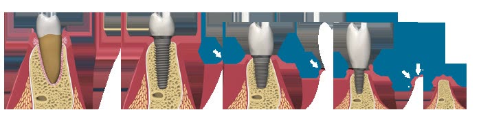 Ilustrație a inserării implantului în os resorbit, cu adiție de biomaterial pentru refacerea volumului osos pierdut