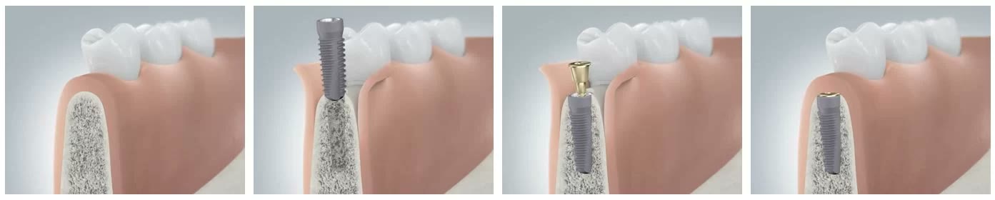 Ilustrație în patru cadre: creasta osoasă fără dinte, implantul inserat în os, bontul protetic atașat și implantul acoperit la nivelul gingiei