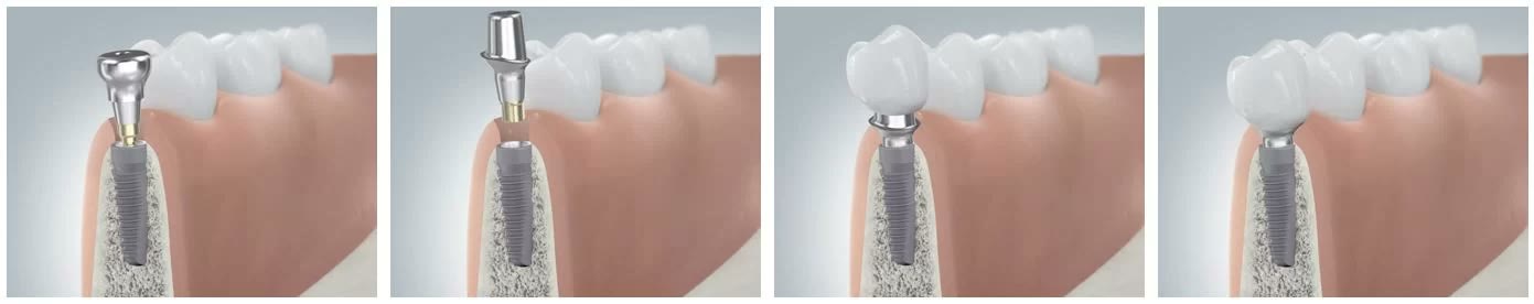 Ilustrație a etapelor protetice: bontul protetic montat pe implant și coroana finalizată, integrată între dinții vecini