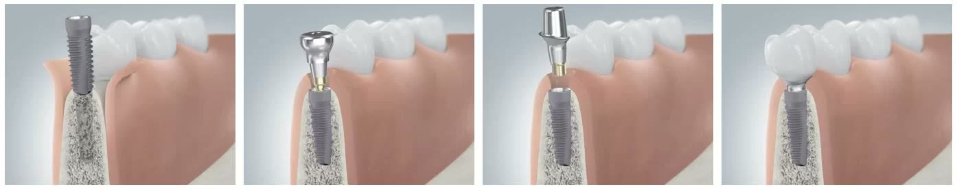 Ilustrație a încărcării implantului: implantul în os, bontul protetic atașat și coroana definitivă montată