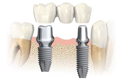 Punte dentară din trei elemente, pregătită pentru fixare pe două implanturi cu bonturi protetice