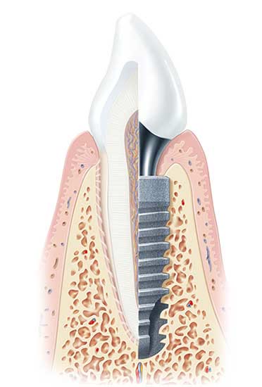 Secțiune prin os și gingie: implantul dentar alături de rădăcina unui dinte natural