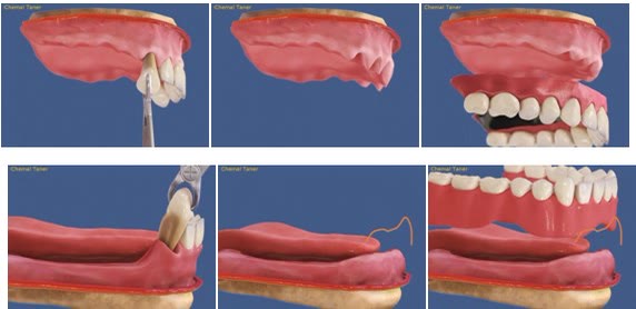 Extracția dinților compromiși și protezarea totală clasică, la maxilar și la mandibulă — situația de dentiție terminală