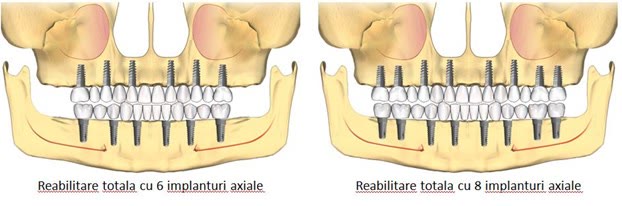 Reabilitare maxilară cu implanturi inserate axial, în os prezent în toate cele patru zone osoase